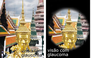 Glaucoma